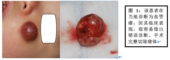 儿童钙化上皮瘤(毛母质瘤)手术时机及治疗方案的选择