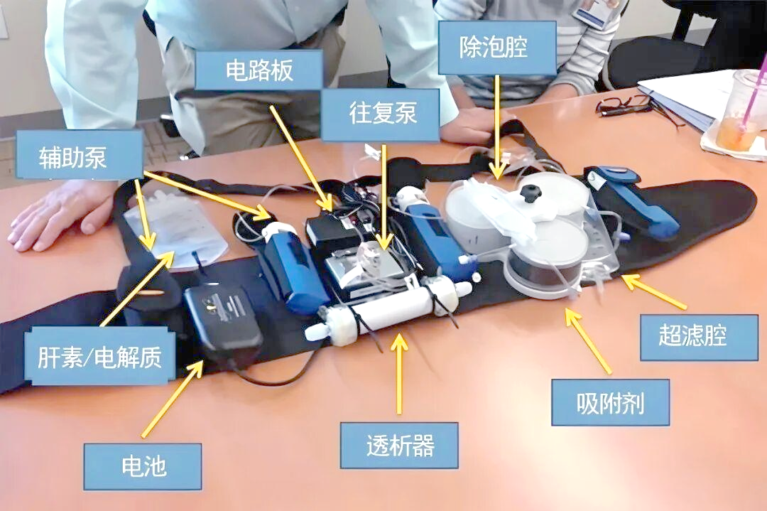 植入式人工肾:开启自由生活的未来