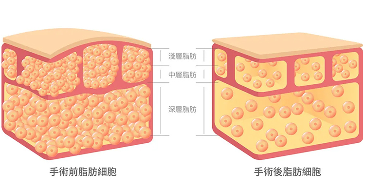 「杭州艺星」做背部吸脂前后有哪些注意事项?