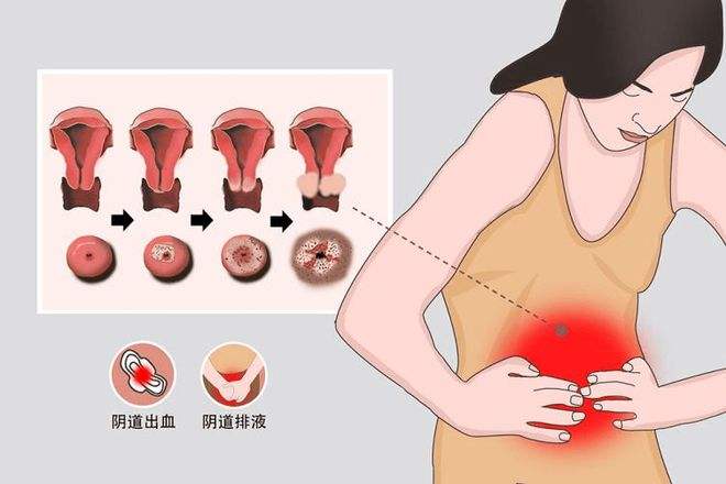 女性患上宫颈癌有什么症状表现?如何有效预防