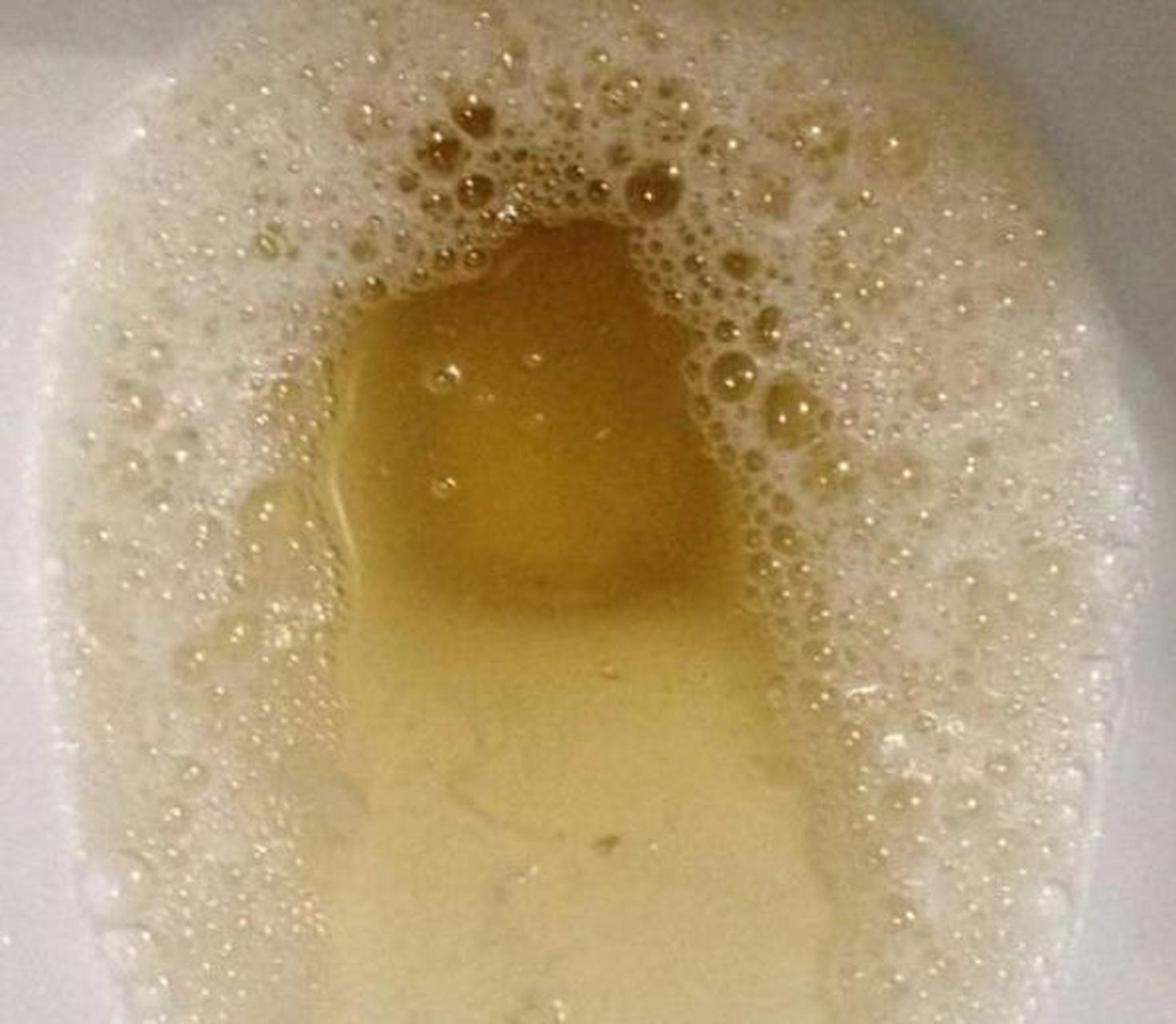 肾病:隐形健康杀手背后的真相