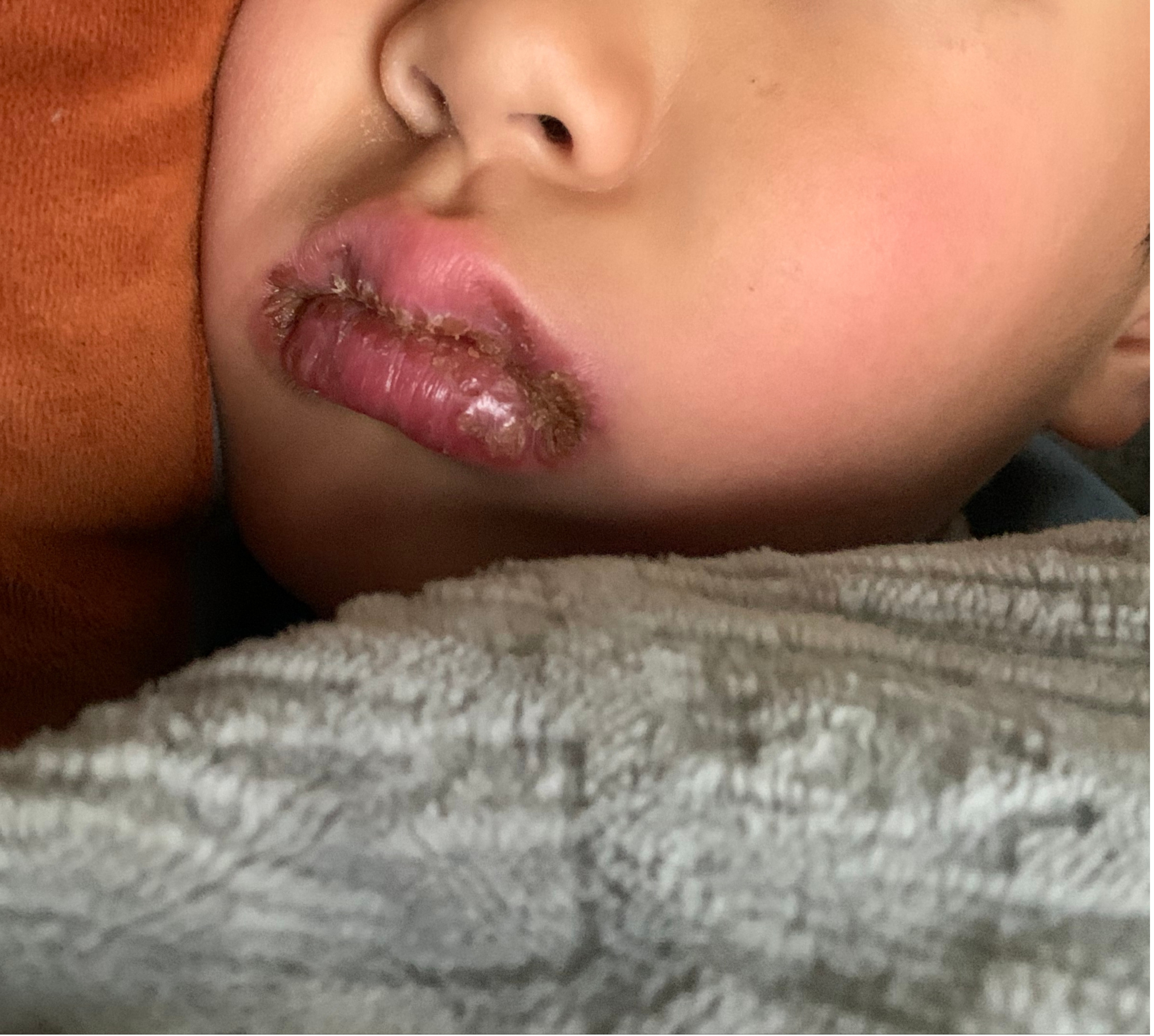 发热,烂嘴角,可能是"唇炎"在作祟,医生提醒:冬季儿童唇炎进入高发期