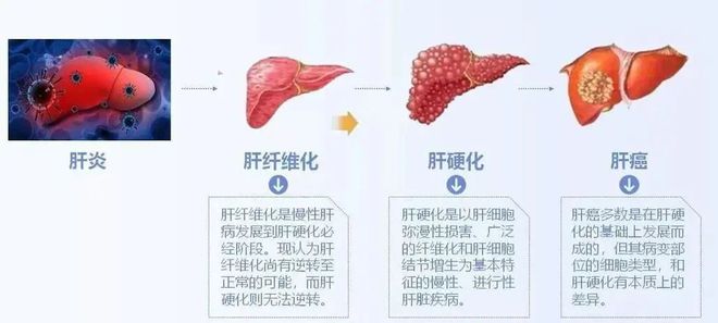 全國愛肝日青島內分泌糖尿病醫院專家科普肝臟健康知識