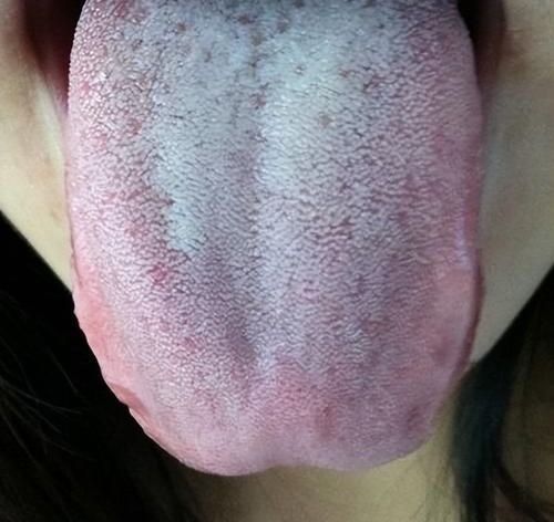 脾胃虚弱舌苔有哪几种