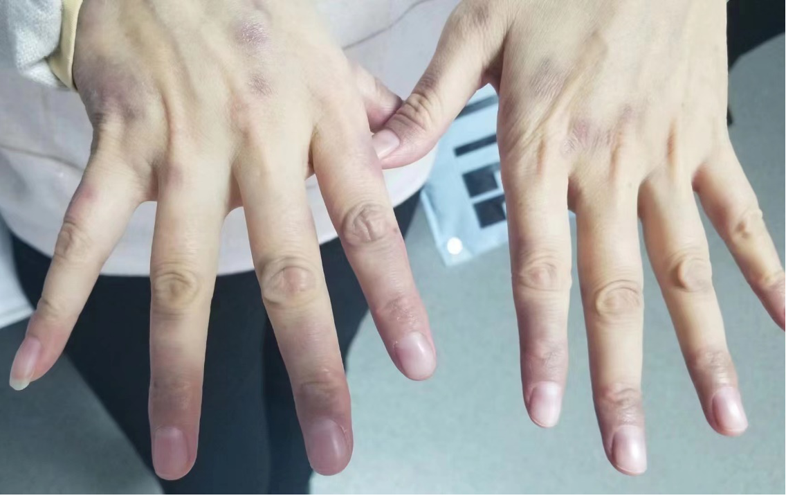 手指变成了「棒槌」!三位患者现身说法:出现这种症状小心肺癌