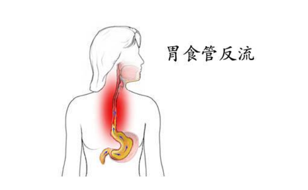 胃食管反流病:嗓子不舒服可以通過嚼口香糖改善