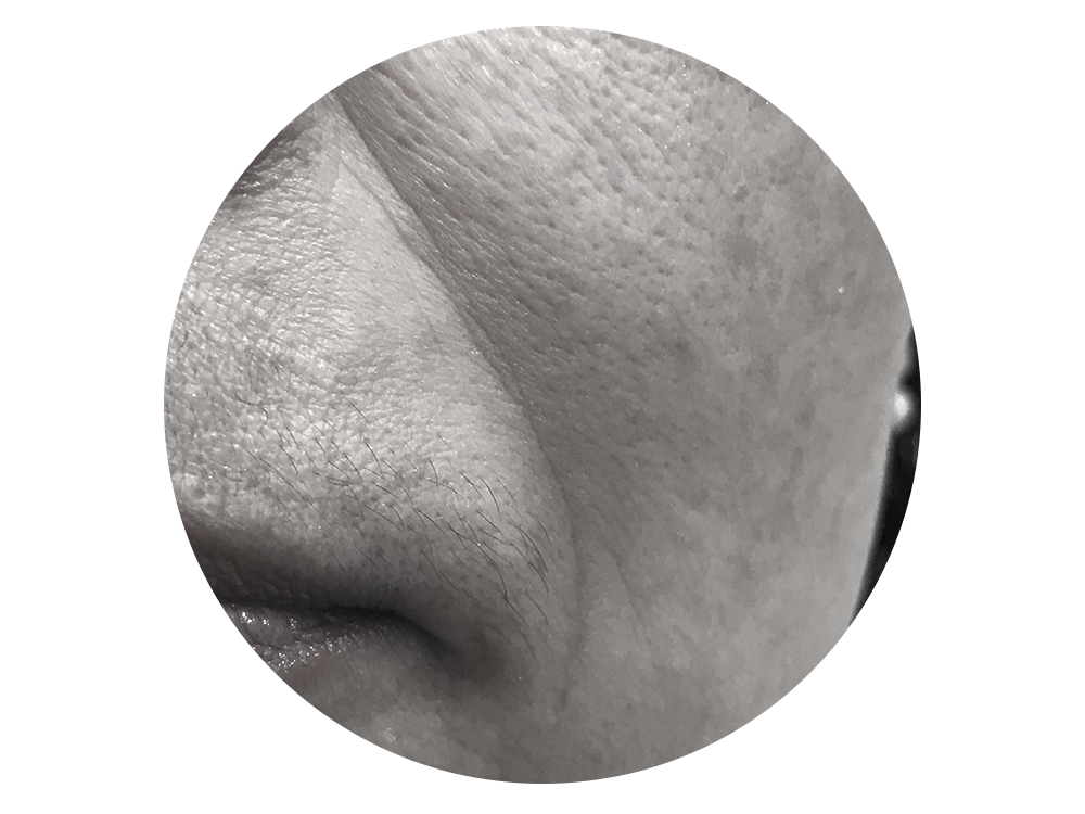 法令纹是位于鼻翼边延伸而下的两道纹路 也叫"括号纹" 肌肤老化松弛和