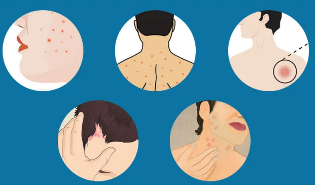 究竟是什么原因导致毛囊炎?