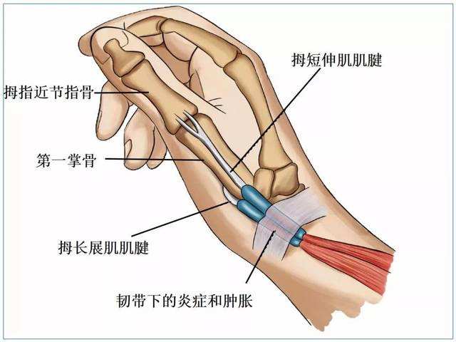 如何判断腱鞘炎图片