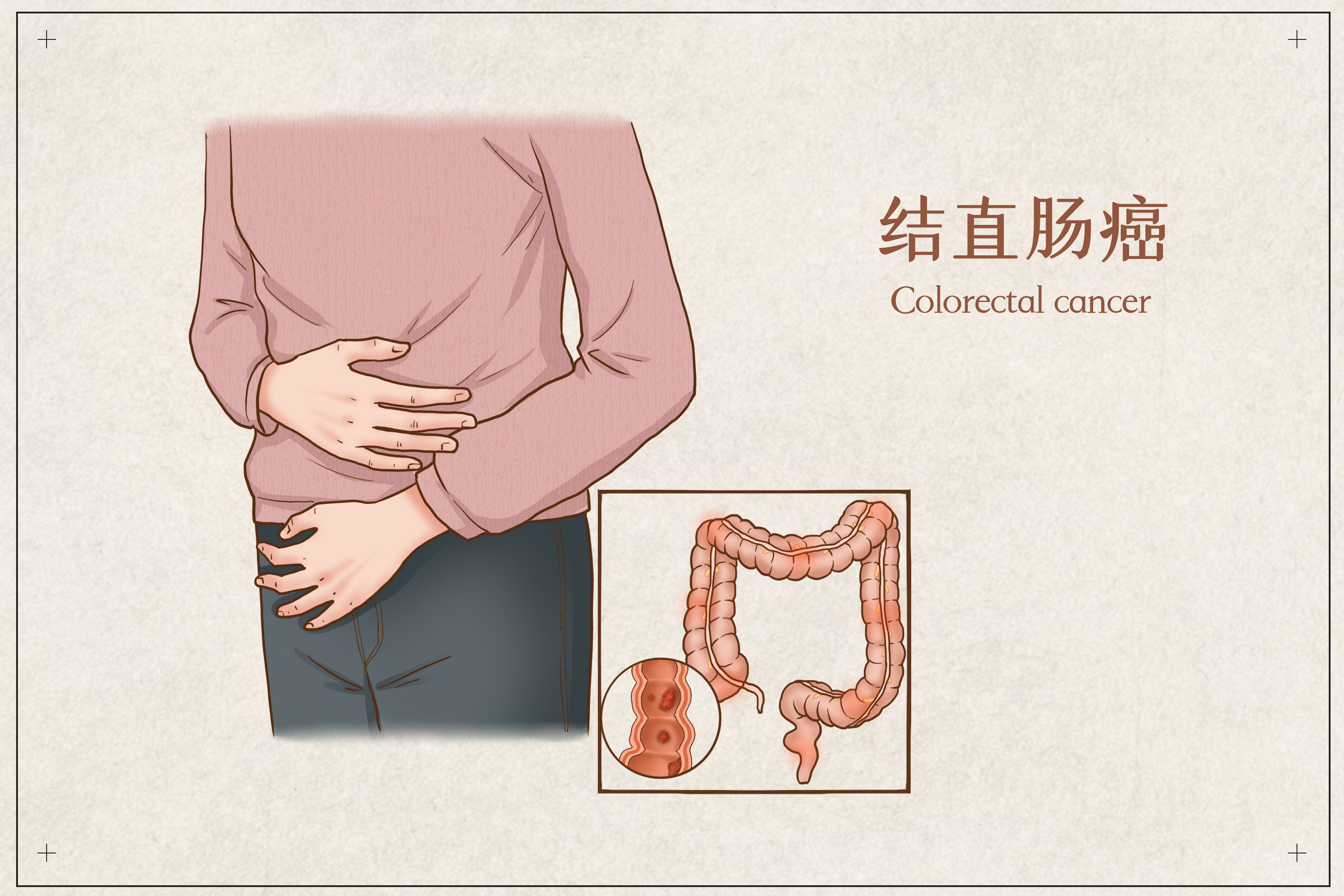 术后会转移吗?肠梗阻还能活多久?