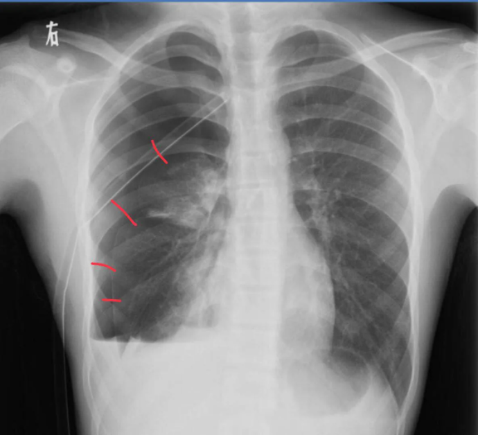 肺纤维化胸片图片