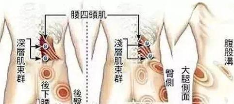 什么是腰背肌筋膜炎?有这4种临床症状的人要注意啦
