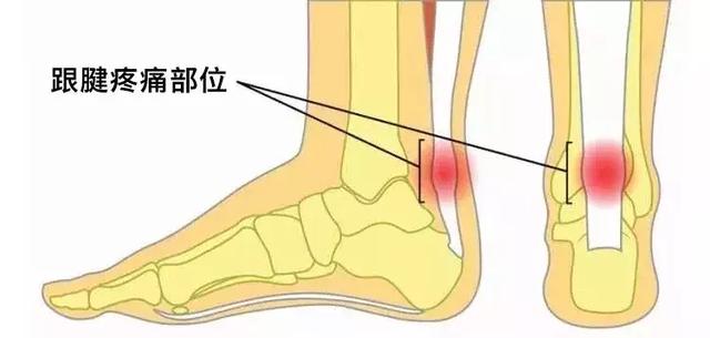 跟腱疼是怎么回事图片