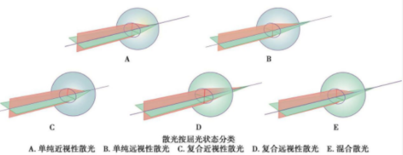 散光的详细分类介绍
