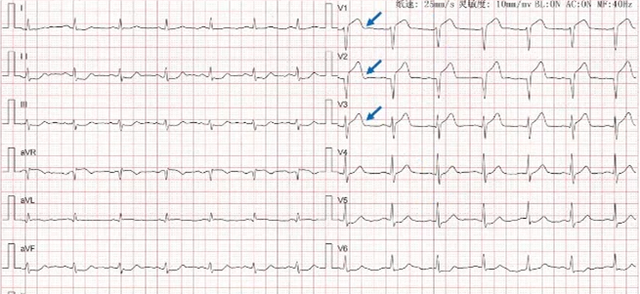 左主干心梗心电图表现图片