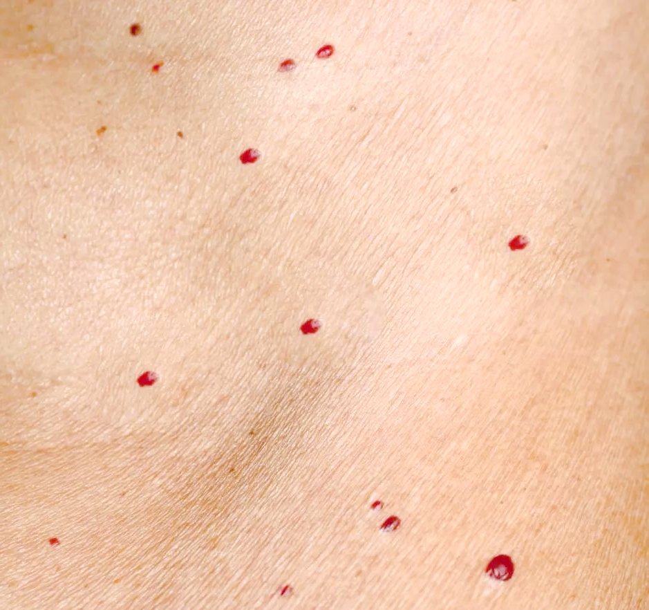 年轻人皮肤红痣现象及其背后的知识
