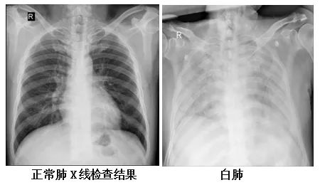 健康肺部x光片图片