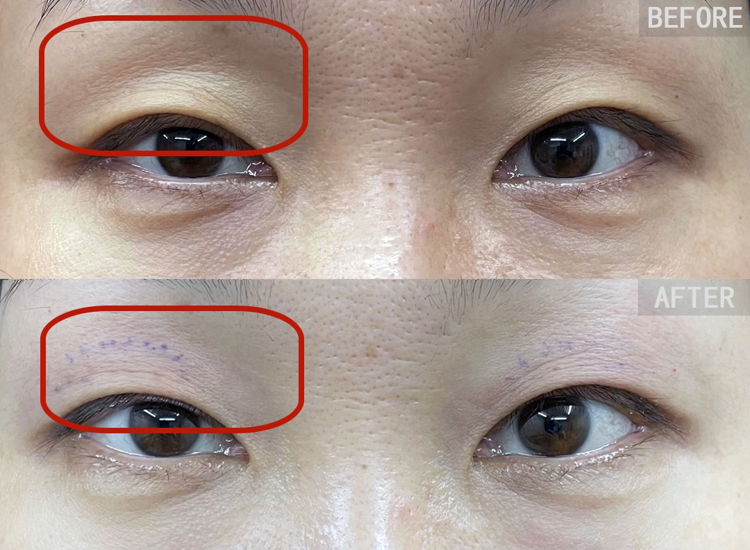 才30岁,年纪轻轻眼窝凹陷很显老,什么项目可以改善?