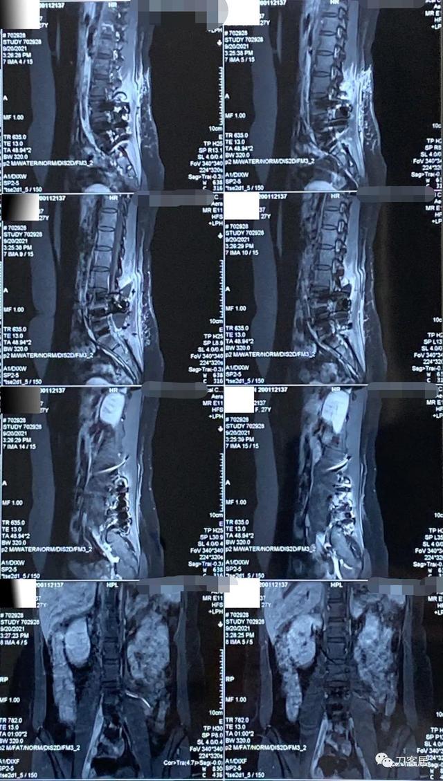 28岁女腰椎间盘突出图片