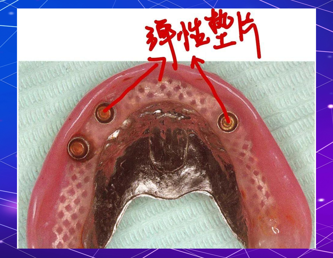 种植覆盖义齿中的locator基台与杆卡附着体解析
