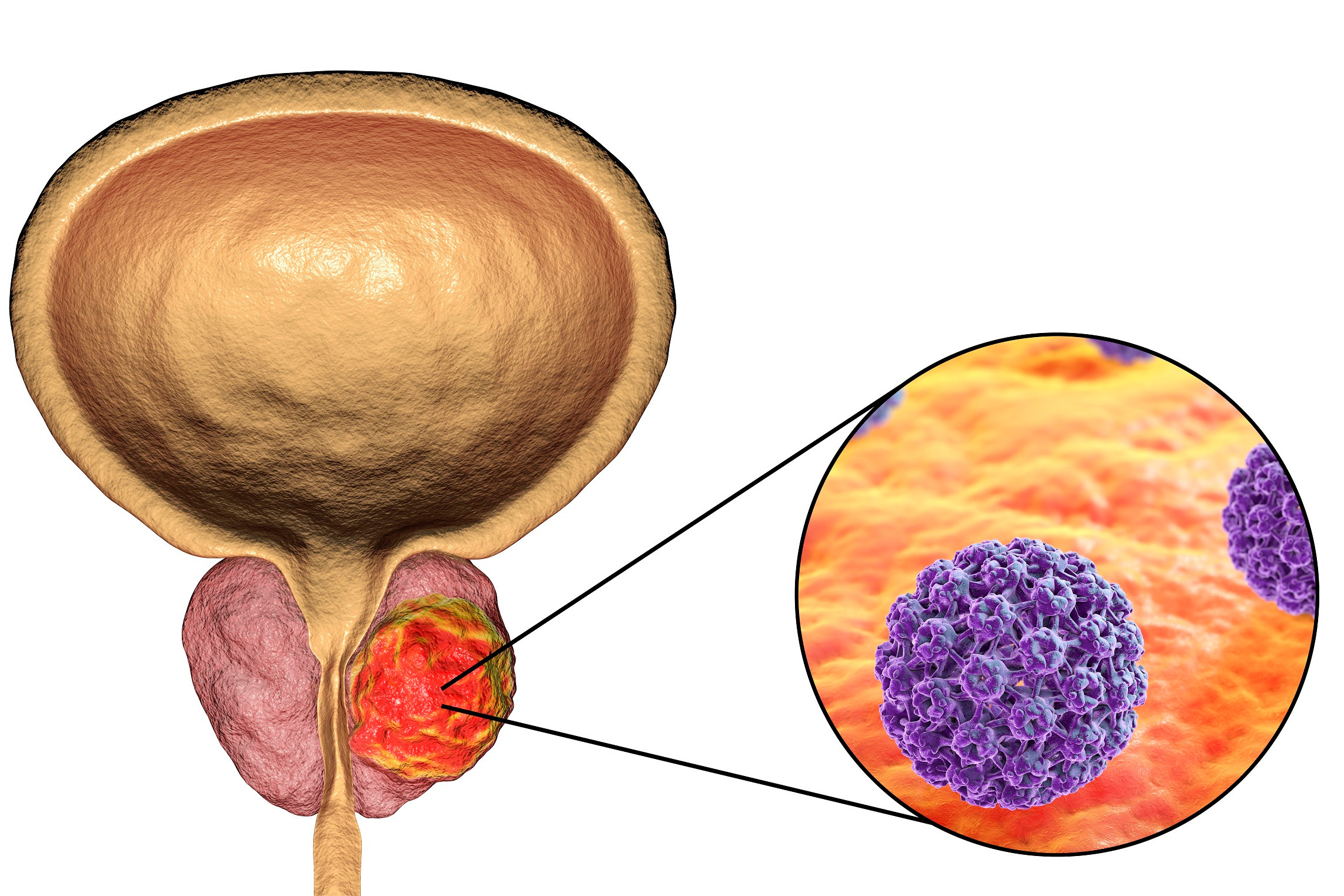 于加军医生:如何区分早期和晚期前列腺癌?