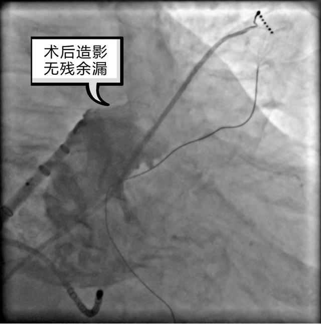 潍医附院心血管内科成功开展首例marshall静脉酒精消融联合导管消融