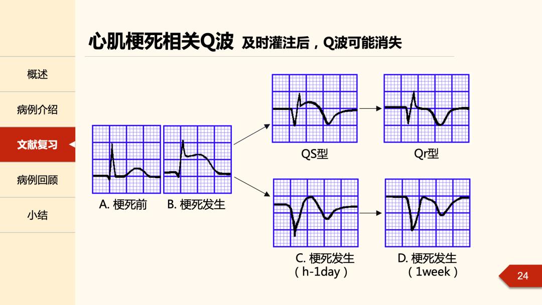 心电图q波正常值图片