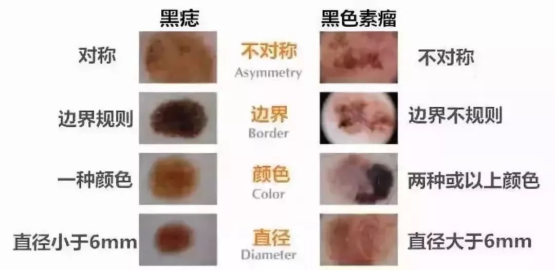 如何区分普通痣与黑色素瘤?5个细节要掌握