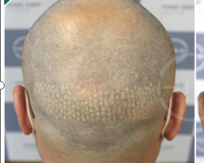 黑米3d纹发:植发提取后枕部的毛囊,会对取发处会有影响吗?