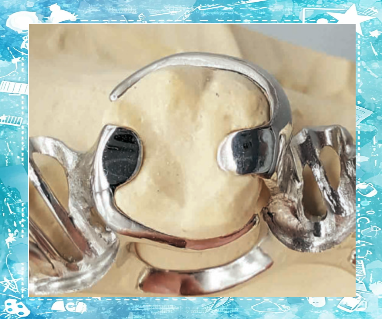 可摘局部义齿卡环的设计与分类详解