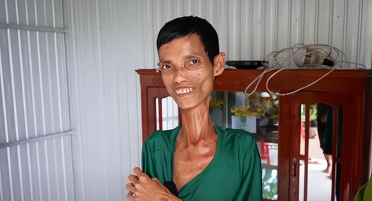 过度厌食到底多恐怖?身高一米七八的男人,体重居然只有39公斤!