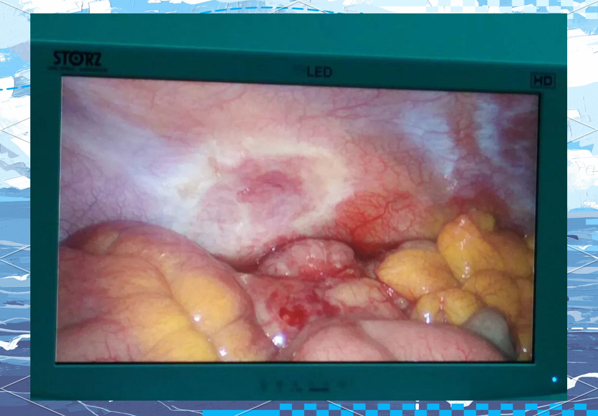 2022年多例手术之一:治疗反复发作的阑尾炎