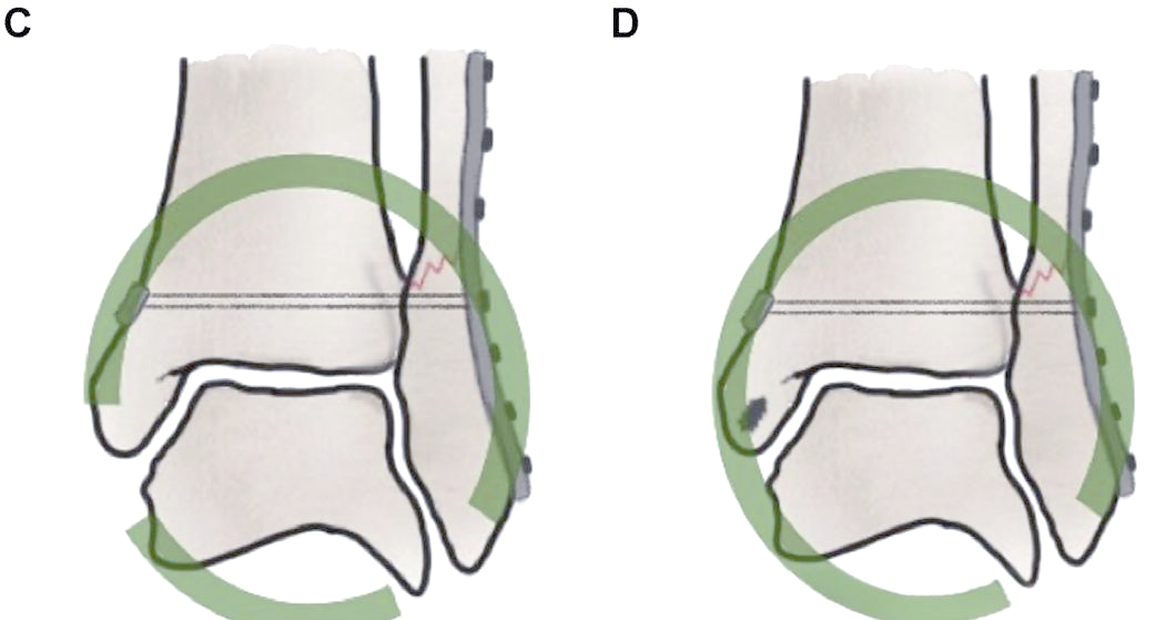 踝关节骨折中三角韧带修复的适应症与技巧