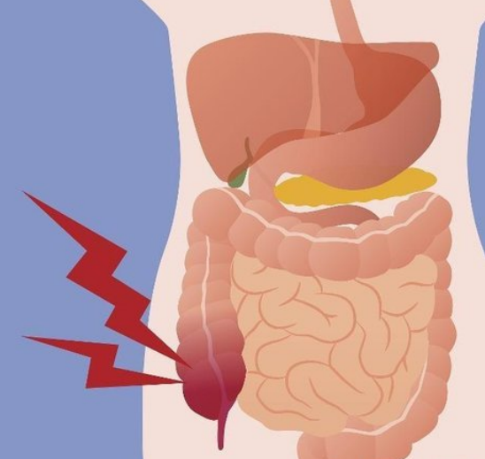 肠痈会出现哪些并发症?一旦出现症状要就医
