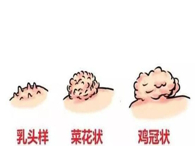 得了尖锐湿疣可以怀孕吗?