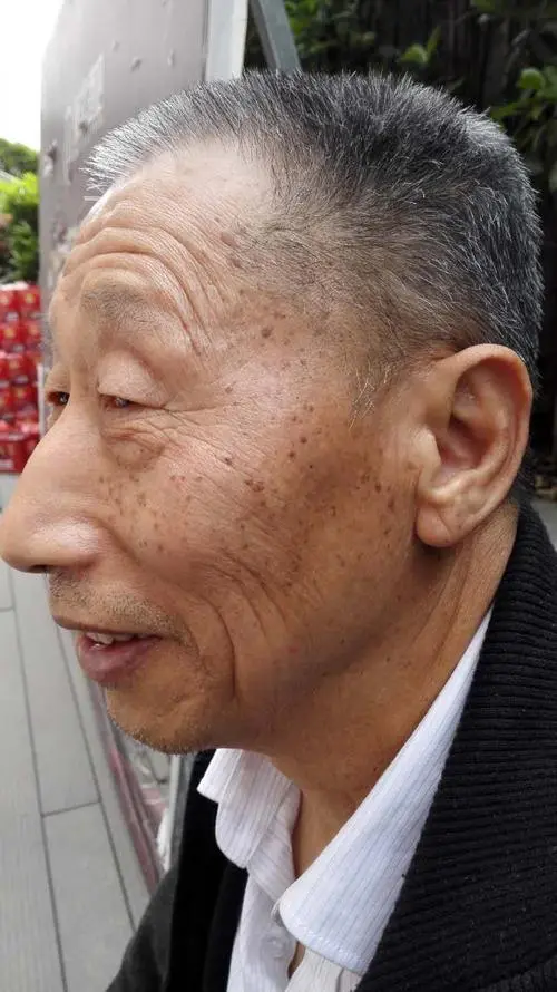 想要改善老年人脸上的老年斑,要把这5件事情做好才行