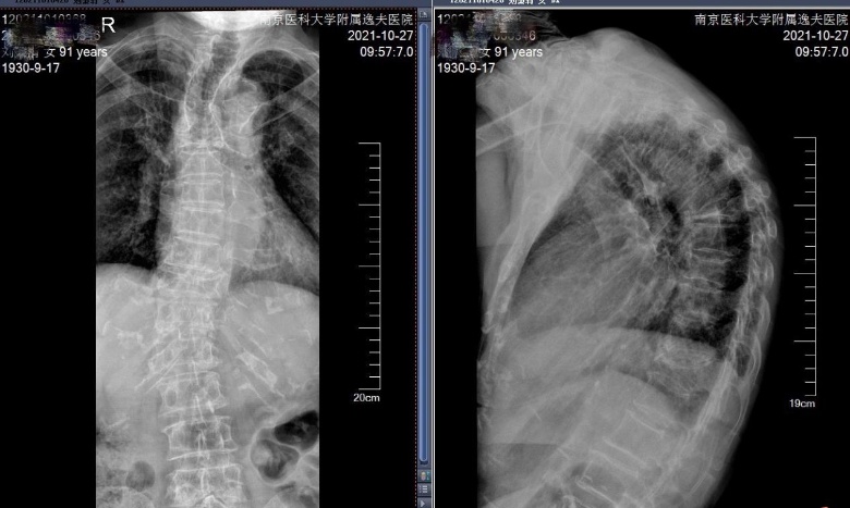 91岁老太两次胸椎骨折致驼背,骨科微创技术让她又挺直"腰杆"