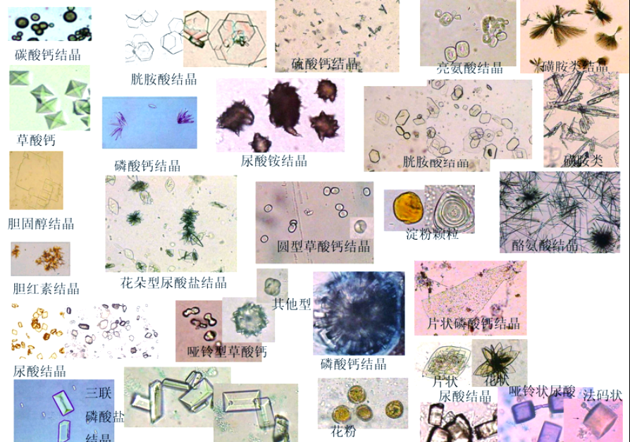 尿液结晶的种类与临床意义解析