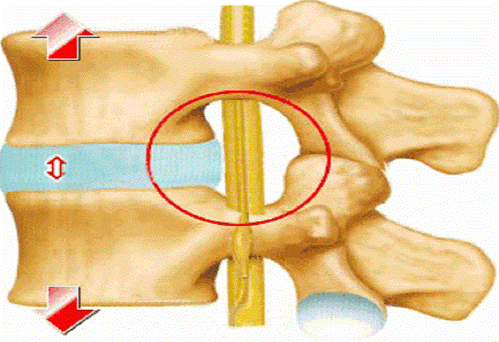 腰椎第四五节膨出图片图片