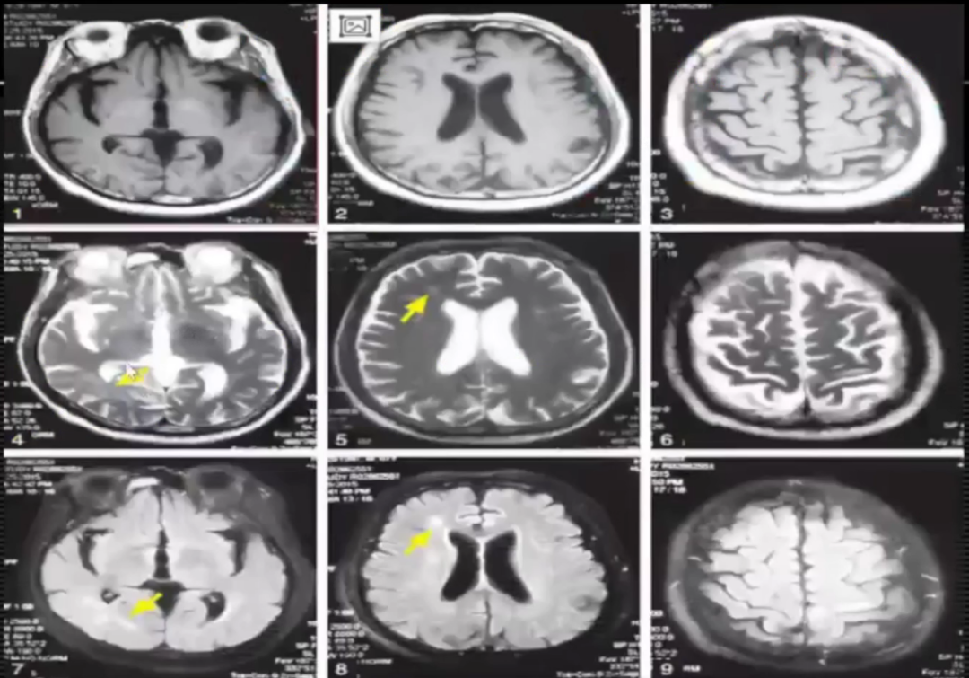 脑梗核磁图片解说图图片