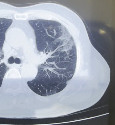 肺粘液腺癌,是一种会伪装成"肺炎"和"良性结节"的癌细胞!