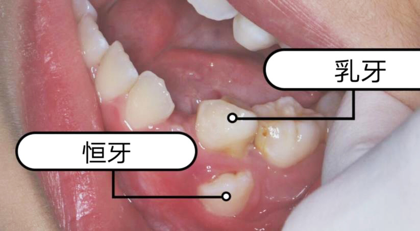 乳牙滞留影响大,这样做有利儿童健康