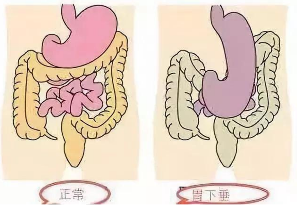 产后胃下垂的症状图片图片
