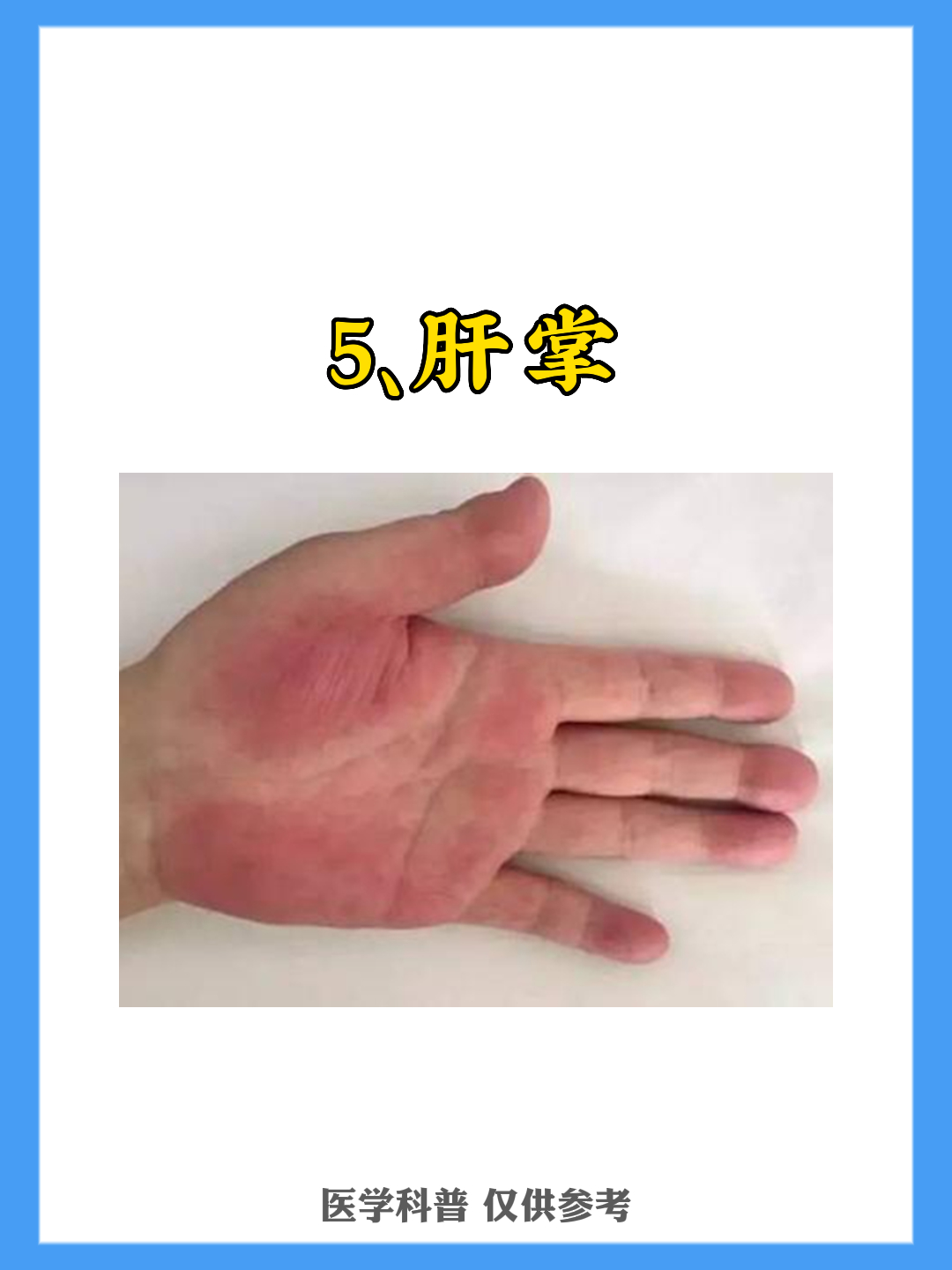 5大症状,乙肝患者,要格外小心!