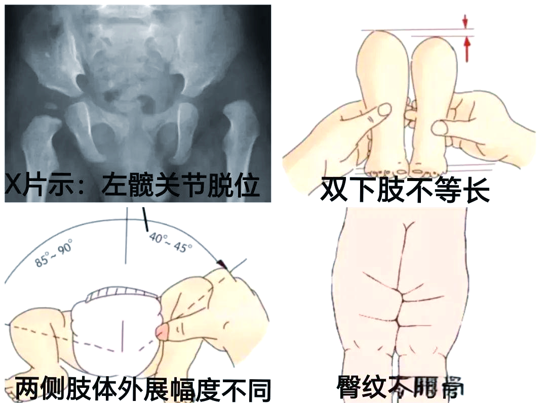 先天性髋关节脱位的预防,诊断与治疗策略