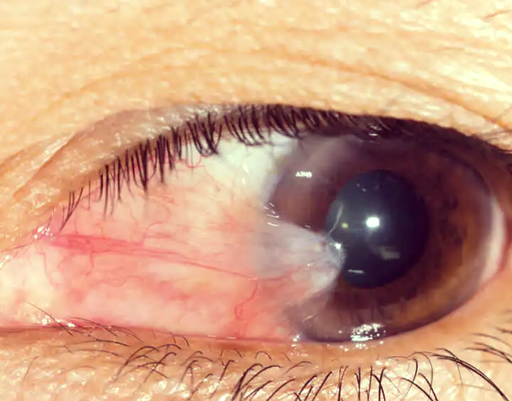 翼状胬肉:眼表疾病的"小翅膀",如何应对?