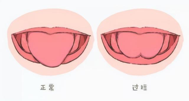 儿童舌系带图片大全图片