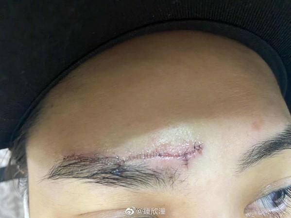 伤口缝针跟眉毛一样长