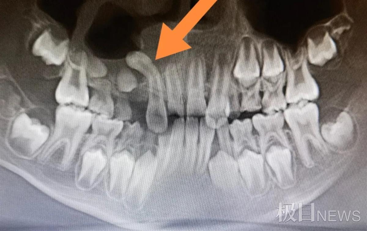 9岁男童多长一颗牙,180度倒置反转让专家直呼罕见