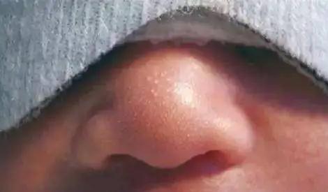 婴儿鼻子上有小白点能用手挤吗(婴儿鼻子上的白点可以不管吗)